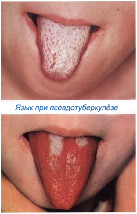 Яркая сыпь на языке Яркая сыпь на языке